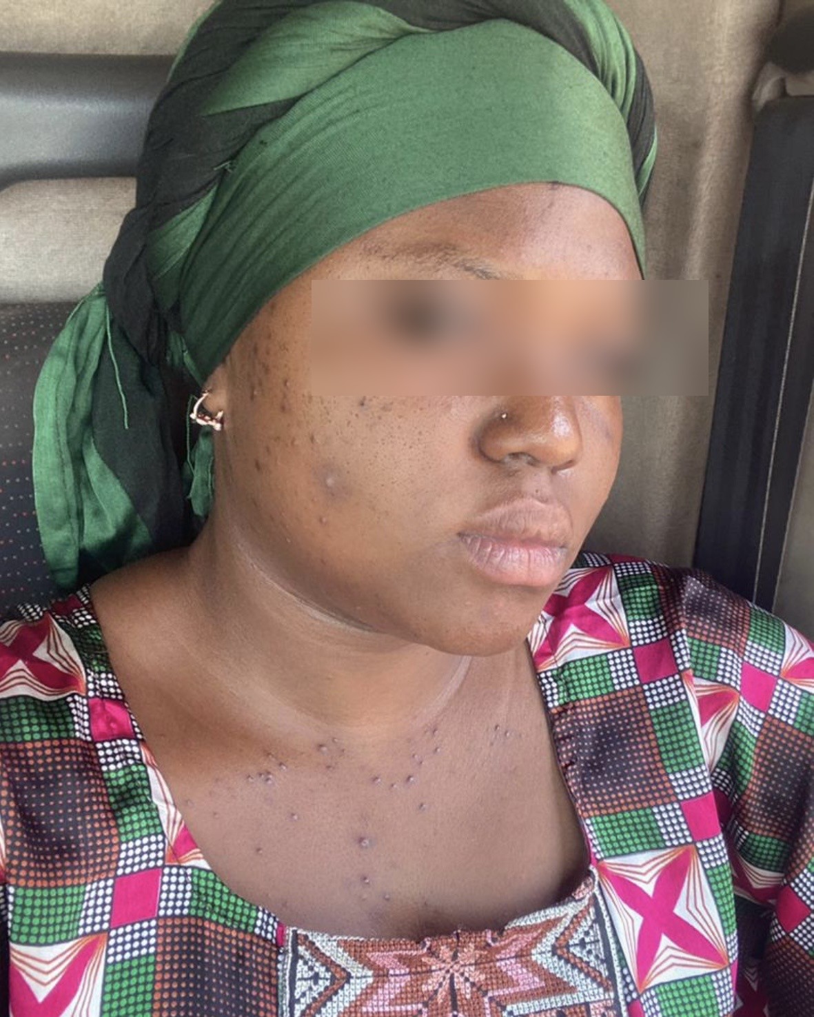 Peau de Fatima avant le rituel Riam Cosmetics : hyperpigmentations et taches visibles.